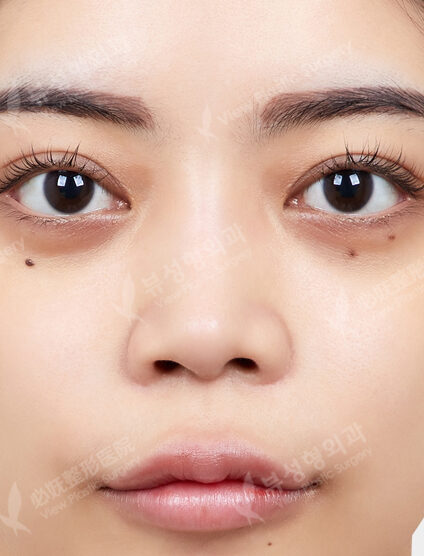 Revisional Rhinoplasty+Osteotomy+Weir Reduction (5 Months) — Before