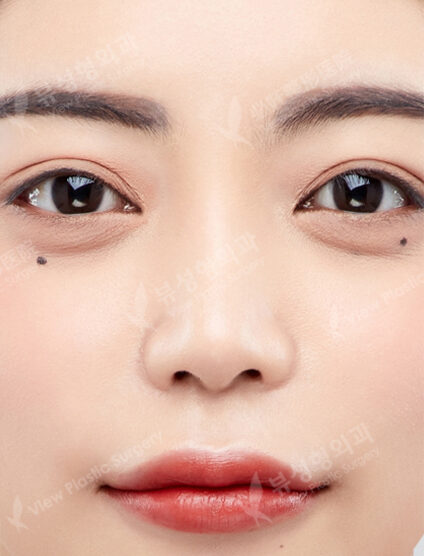 Revisional Rhinoplasty+Osteotomy+Weir Reduction (5 Months) — After