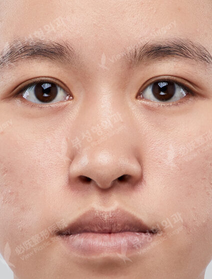 Rhinoplasty (GoreTex Foreign Body)+ Conchal Cartilage Graft(3 Months) — Before