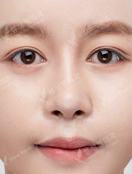 Rhinoplasty (GoreTex Foreign Body)+ Conchal Cartilage Graft(3 Months) — After