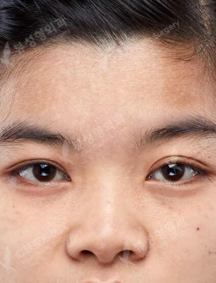 Rhinoplasty (Silicone donated cartilage)+ Lengthening(3 Months) — Before