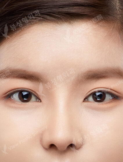 Rhinoplasty (Silicone donated cartilage)+ Lengthening(3 Months) — After