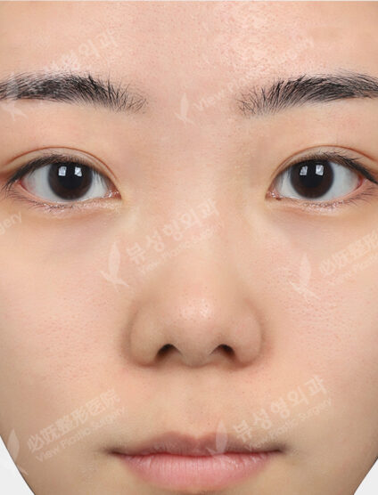 Rhinoplasty+Lengthening +GoreTex (3 Months) — Before