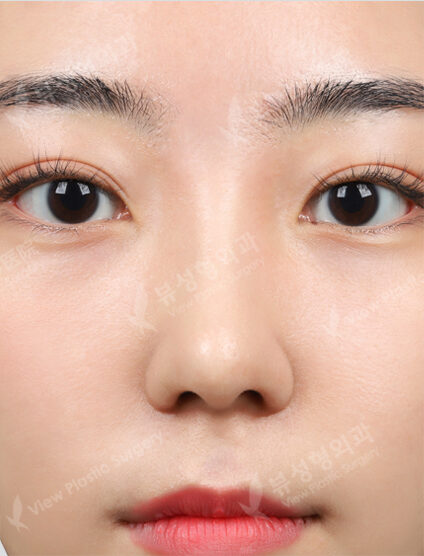 Rhinoplasty+Lengthening +GoreTex (3 Months) — After
