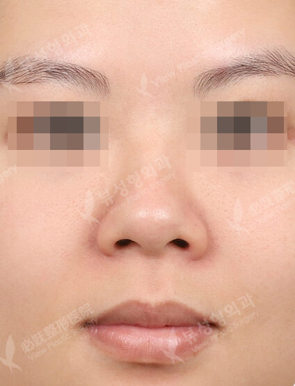 Nose(Hump Nose )+ Epicanthoplasty+Liposuction (ChinLine , Frontal Cheeks)(3 Months) — Before