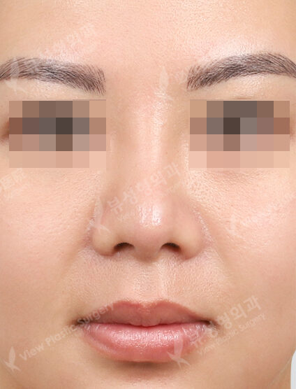 Nose(Hump Nose )+ Epicanthoplasty+Liposuction (ChinLine , Frontal Cheeks)(3 Months) — After