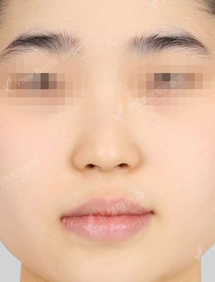 Natural Vline+Zygoma Reduction+Combination Ptosis Correction Surgery+Epicanthoplasty+Lateral Canthoplasty+Lower Canthoplasty+Nose(23 Week) — Before