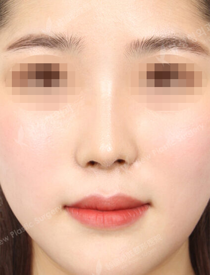 Natural Vline+Zygoma Reduction+Combination Ptosis Correction Surgery+Epicanthoplasty+Lateral Canthoplasty+Lower Canthoplasty+Nose(23 Week) — After