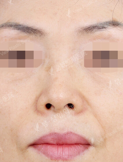 Short Nose (5 Months ) — Before
