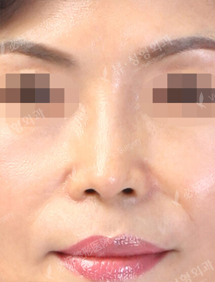 Short Nose (5 Months ) — After