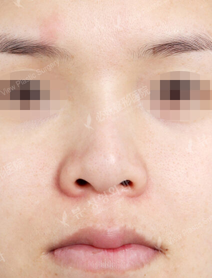 Bulbous Nose (1 Months ) — Before