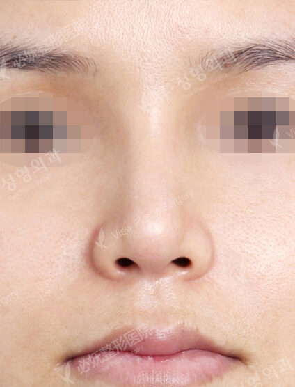 Bulbous Nose (1 Months ) — After