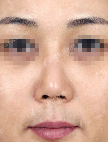 Short Nose (Revisional Rhinoplasty) (1 Months ) — Before