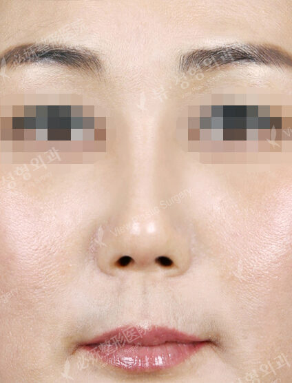 Short Nose (Revisional Rhinoplasty) (1 Months ) — After