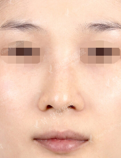 Hump Nose(2 Months ) — Before