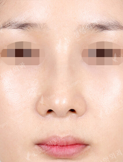 Hump Nose(2 Months ) — After