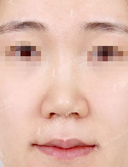 Bulbous Nose (5 Months ) — Before