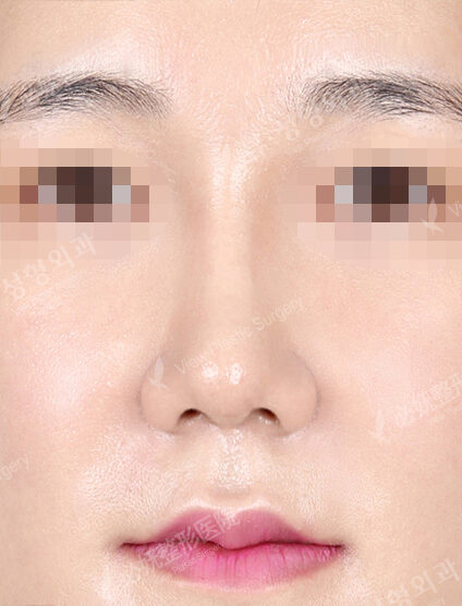 Bulbous Nose (5 Months ) — After