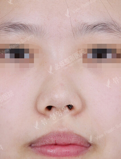 Short Nose (1 Months ) — Before
