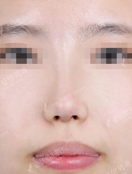 Short Nose (1 Months ) — After