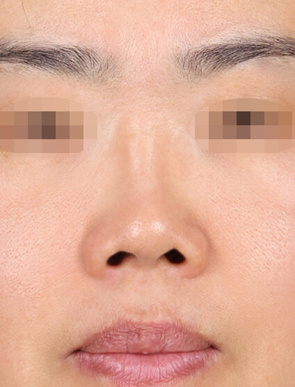 Short Nose (Revisional Rhinoplasty) (1 Months ) — Before