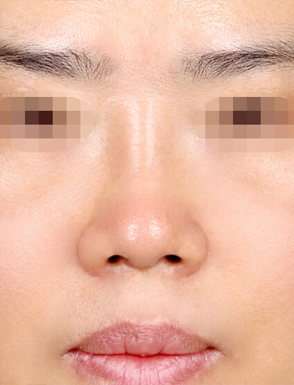 Short Nose (Revisional Rhinoplasty) (1 Months ) — After