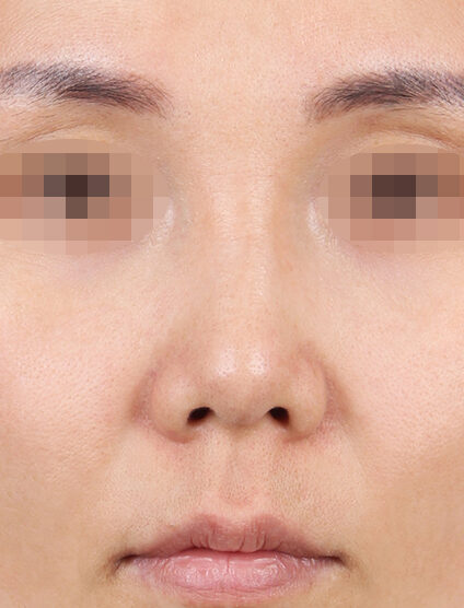 Short Nose (2 Months ) — Before