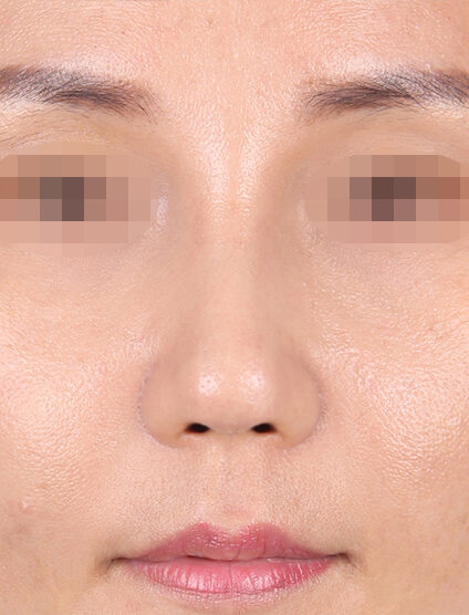 Short Nose (2 Months ) — After
