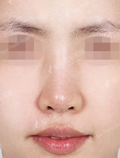 Low Nose (Revisional Surgery) (4 Months) — Before