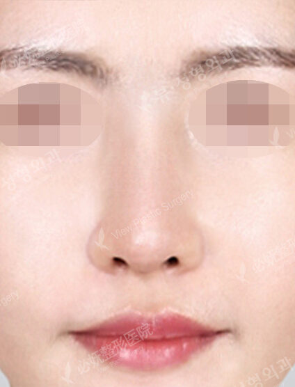 Low Nose (Revisional Surgery) (4 Months) — After