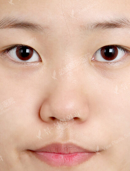 Bulbous Nose+Weir Reduction (4 Months ) — Before