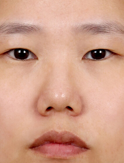 Bulbous Nose (6 Months ) — Before