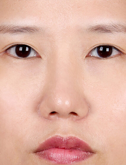 Bulbous Nose (6 Months ) — After