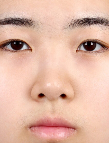 Short Nose (1 Months ) — Before