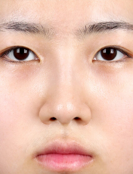 Short Nose (1 Months ) — After