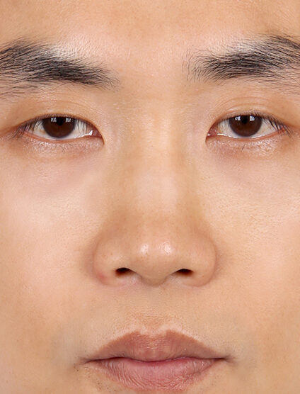 T.O.P Surgery_Hump Nose(4 Months ) — Before