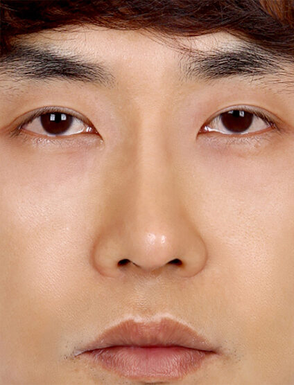 T.O.P Surgery_Hump Nose(4 Months ) — After