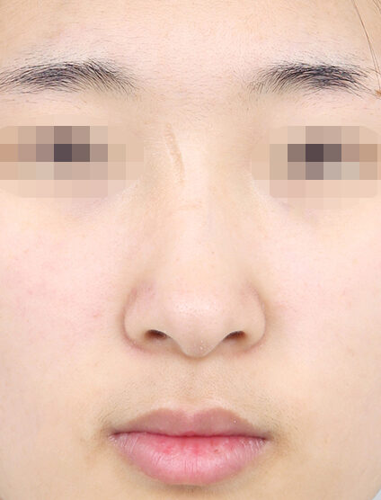 Bulbous Nose (1 Months ) — Before
