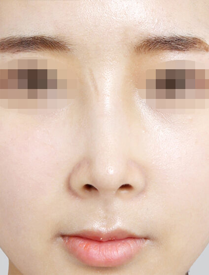 Bulbous Nose (1 Months ) — After