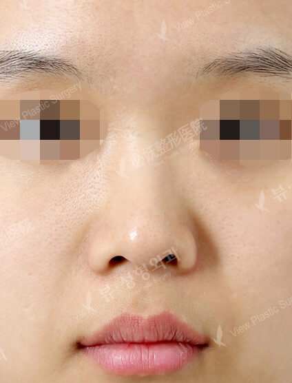 Low Nose (1 Months ) — Before