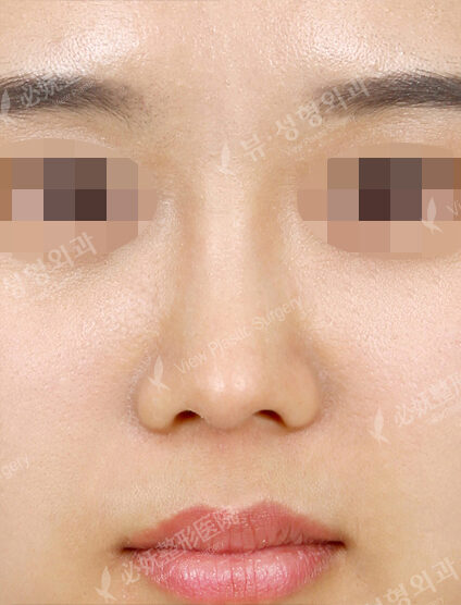 Low Nose (1 Months ) — After