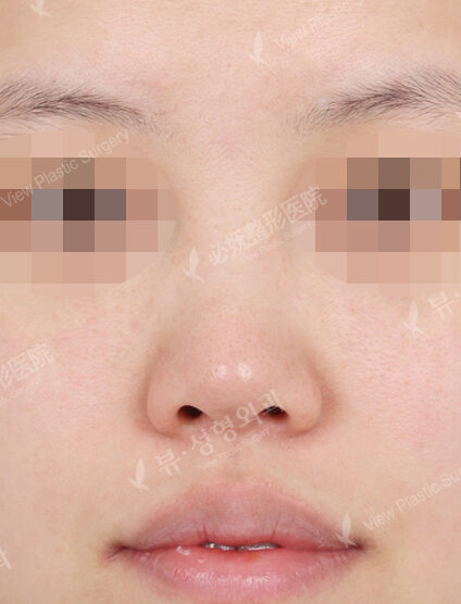 Low Nose (3 Months ) — Before