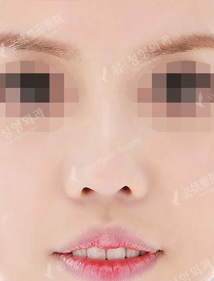 Low Nose (3 Months ) — After