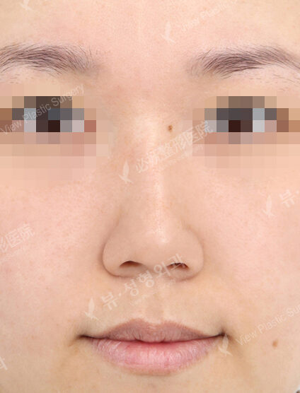 Hump Nose(2 Months ) — Before