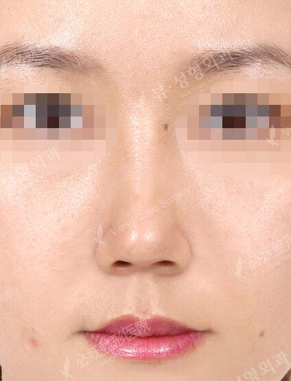 Hump Nose(2 Months ) — After