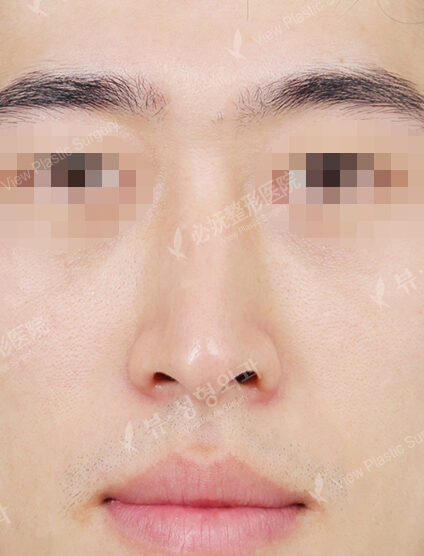 T.O.P Surgery_Hump Nose(10 Months) — Before