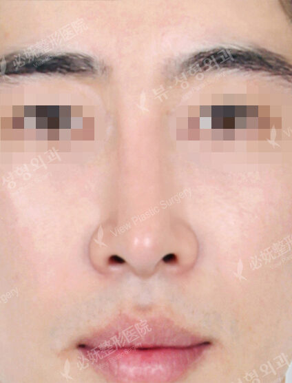 T.O.P Surgery_Hump Nose(10 Months) — After