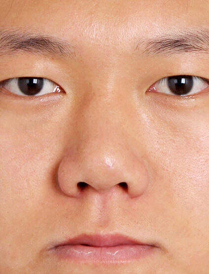 T.O.P Surgery_Low Nose (1 Year2 Months ) — Before