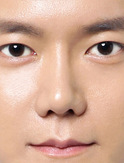 T.O.P Surgery_Low Nose (1 Year2 Months ) — After