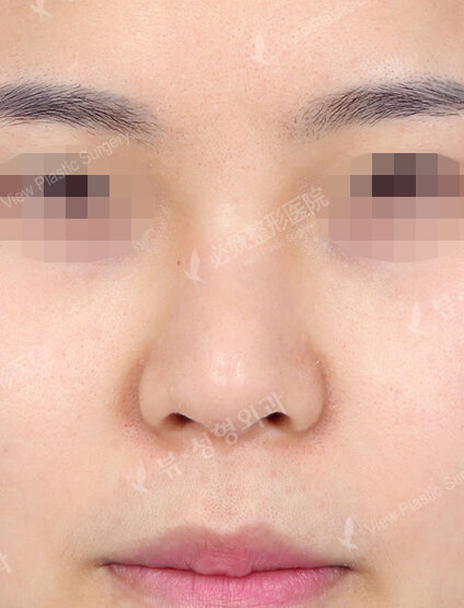 Bulbous Nose (7 Months ) — Before